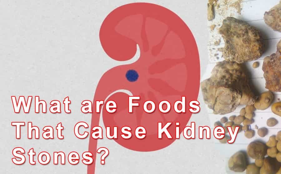 foods that cause kidney stones